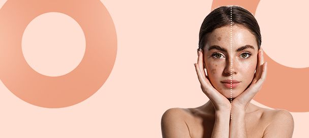 Kobieta z przebarwieniami na twarzy